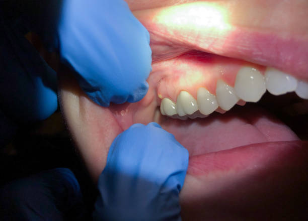 Best Emergency Dentist for Knocked-Out Tooth in Lake Summerset, IL
