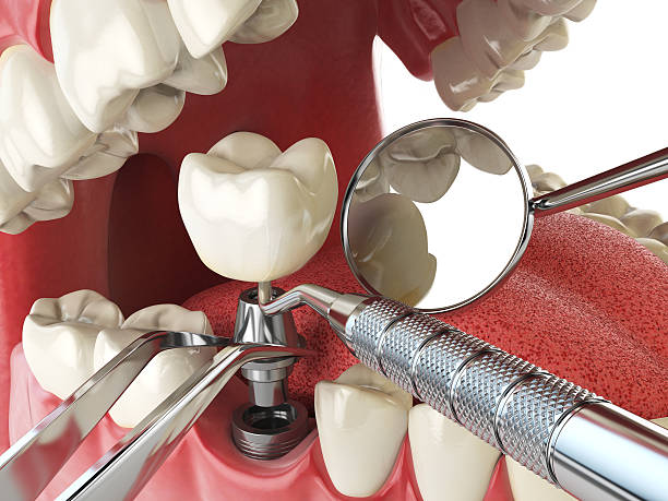 Best Emergency Dental Extractions in Lake Summerset, IL